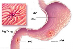 چرا زخم معده می‌گیریم؟