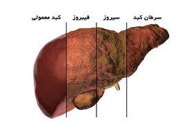 پنج عاملی که خطر ابتلا به بیماری کبدی را افزایش می‌دهد