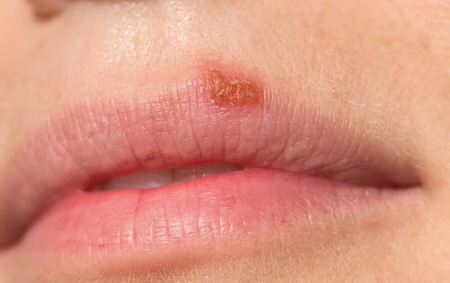 کودکان خردسال را نبوسید/ این کودک چشمش را از دست داد