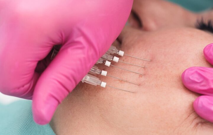 ماجرای ترند زیبایی خطرناک؛ لیفت صورت با نخ