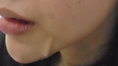 ماجرای ترند زیبایی خطرناک؛ لیفت صورت با نخ