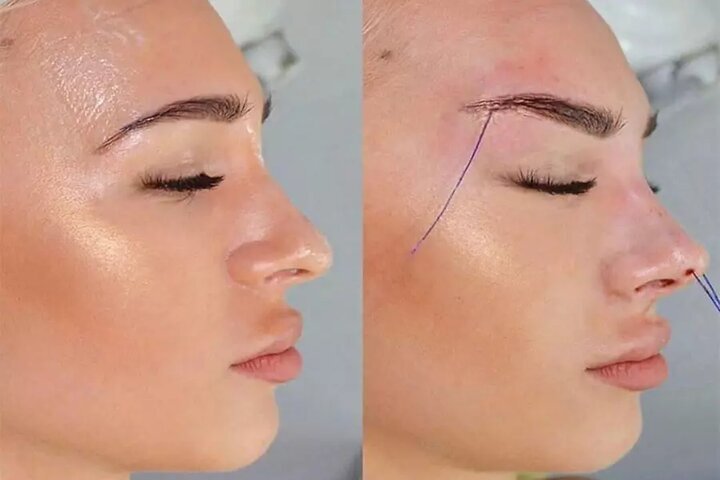 ماجرای ترند زیبایی خطرناک؛ لیفت صورت با نخ