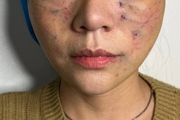 ماجرای ترند زیبایی خطرناک؛ لیفت صورت با نخ