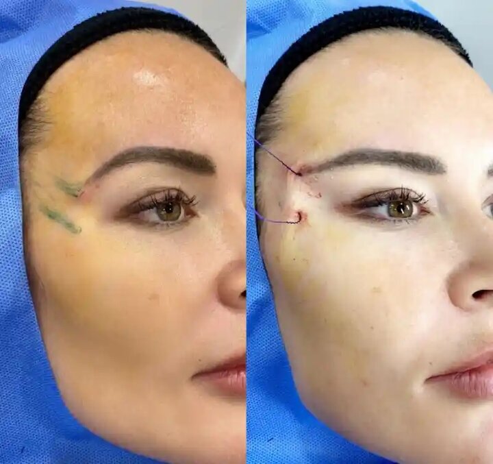 ماجرای ترند زیبایی خطرناک؛ لیفت صورت با نخ
