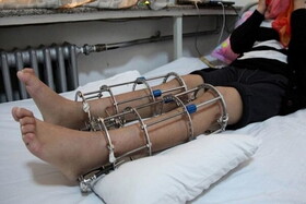 هر آنچه که باید درباره جراحی افزایش قد بدانید