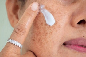 مراقب سوختگی‌های پنهان آفتاب باشید