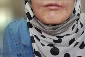 مرد مشهدی لب‌های زن ۱۸ ساله‌اش را دوخت